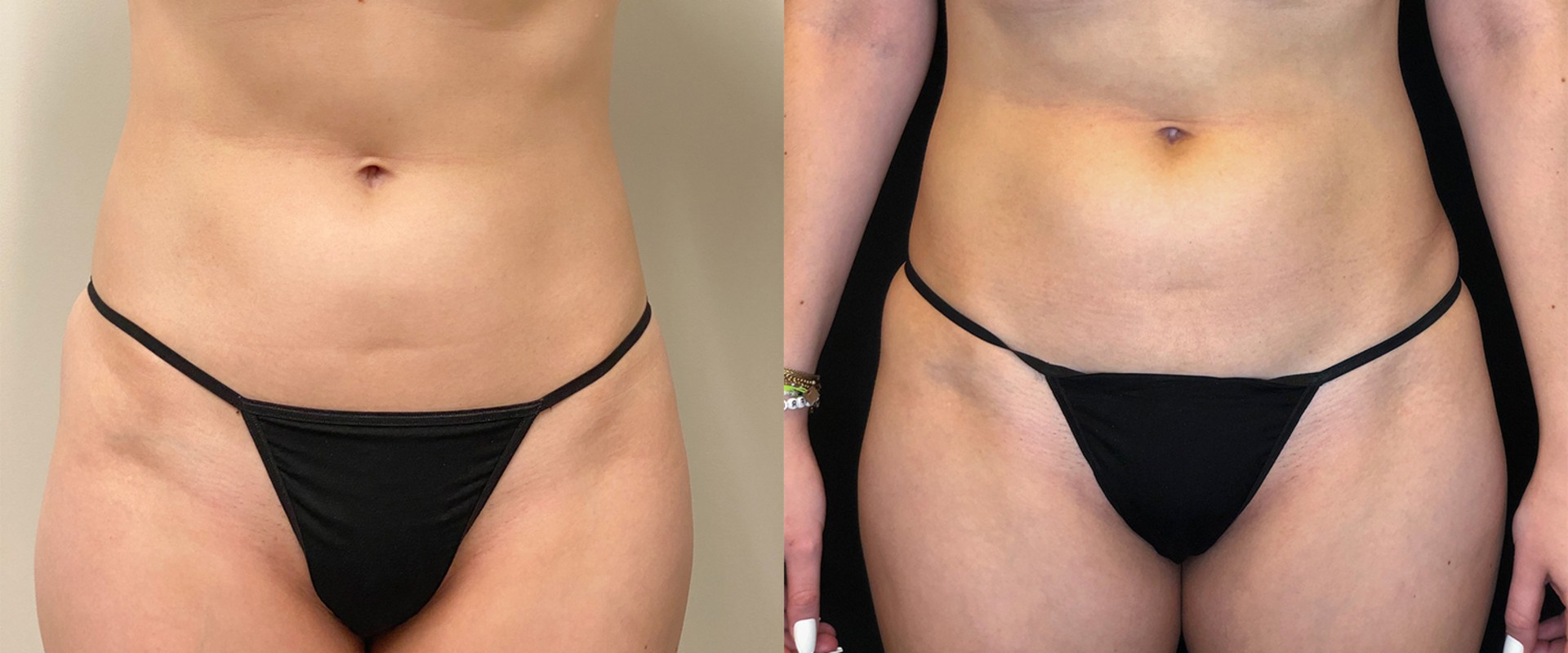 How Much Does Emsculpt NEO Cost? An Expert's Guide