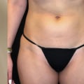 Emsculpt NYC: The Best Way to Get Rid of Unwanted Fat by Precision Aesthetics MD 212-799-1411