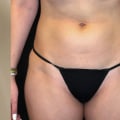 Is EMSCULPT Really Effective?