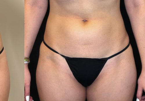 Does EMSCULPT NEO Permanently Remove Fat?