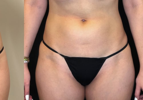 Are the Results of Emsculpt Neo Permanent?